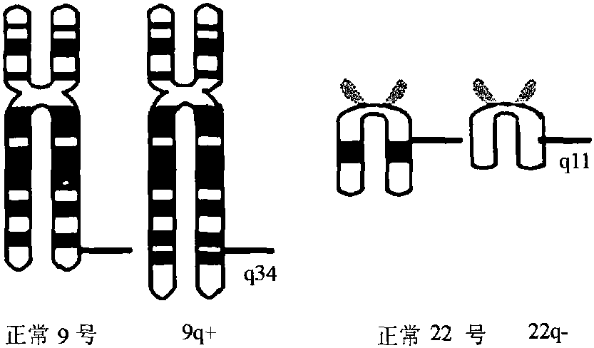 二、慢性粒細(xì)胞白血病(CML)<sup>[29]</sup>